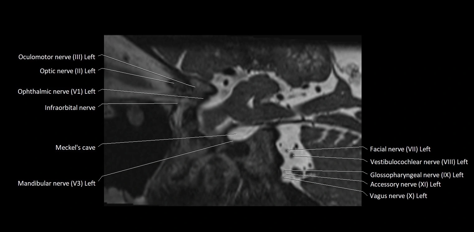 Cranial nerve sagittal anatomy MRI 3T image 18.webp